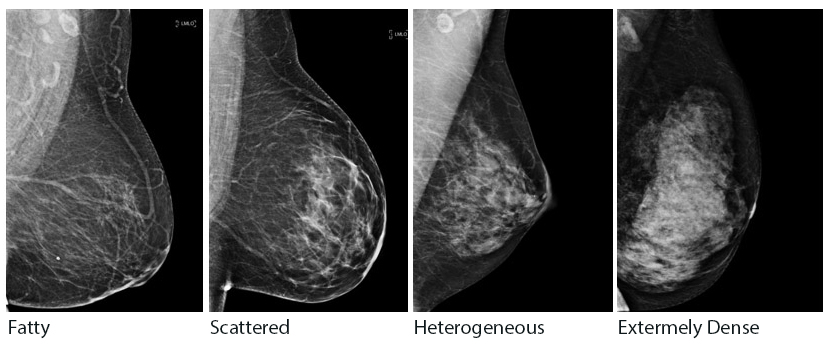 breast density chart from Riverside Cancer Institute