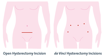 da Vinci Surgical System hysterectomy incision comparison